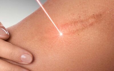 Traitements des cicatrices par le laser fraxel 1550 et l’IPL